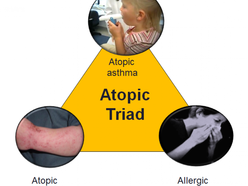 効果あり？スペインでのアトピー治療体験談